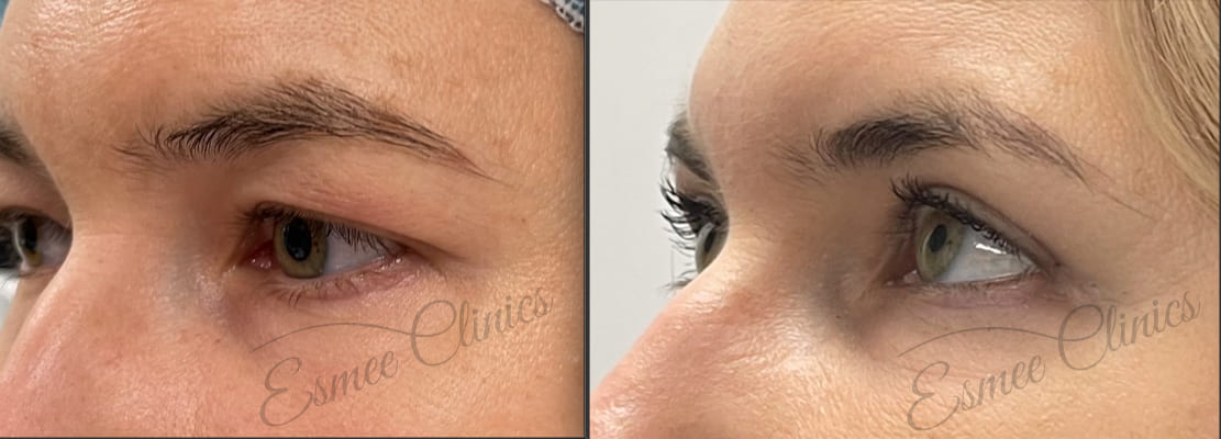 Before and After img